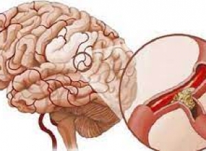 Mối nguy hiểm từ bệnh tai biến và cách phòng chống